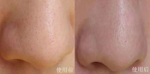 挤痘痘出来的白色的东西是什么