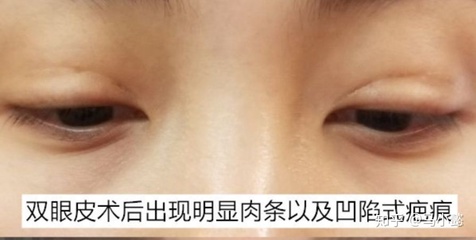 下眼皮凹陷修复哪里好