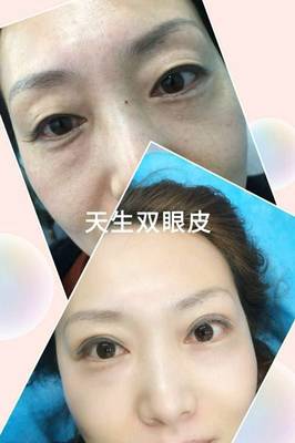 不开刀的双眼皮