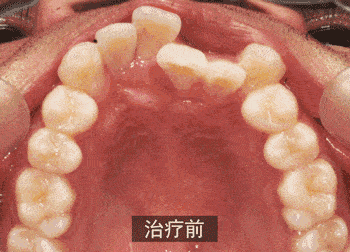牙齿正畸前把牙齿磨小