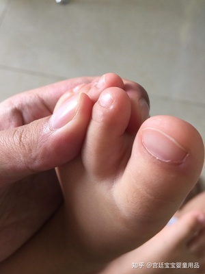 宝宝有脚气怎么办用什么药好