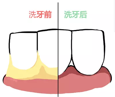 洗牙前要刷牙吗