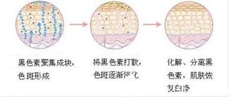 激光祛斑有疤吗