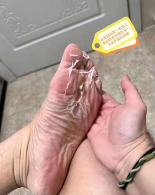 脚板烂了是怎么回事