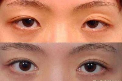 做双眼皮老了会怎样