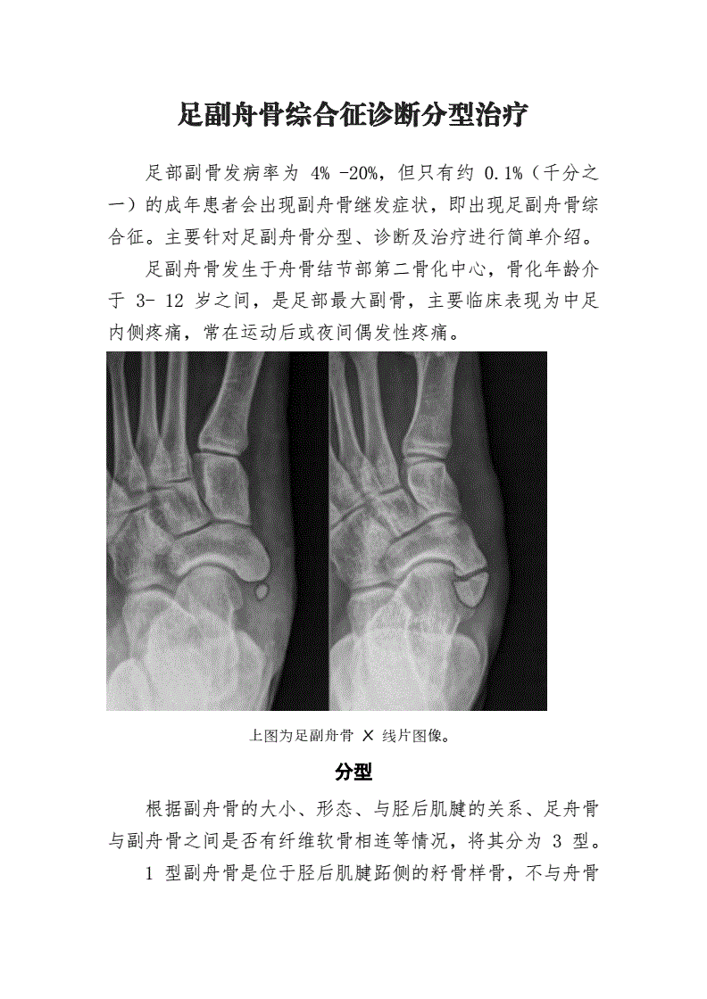 副舟骨怎么治疗最好