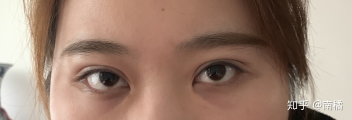 双眼皮太肿