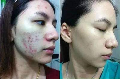 结节型痘痘怎么去