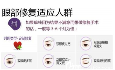 怎样才能有双眼皮