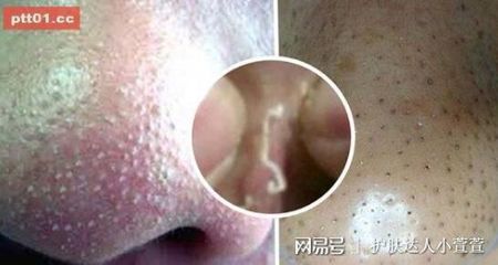 鼻子上面长白色痘痘原因