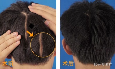 头上有疤痕怎么办