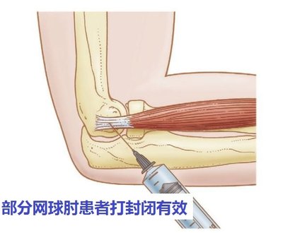 网球肘怎么治疗