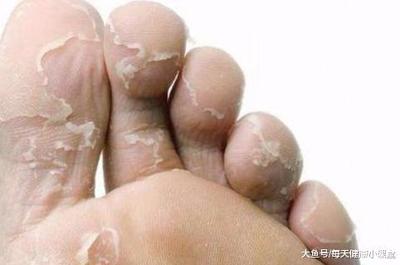 手脚潮湿是怎么回事