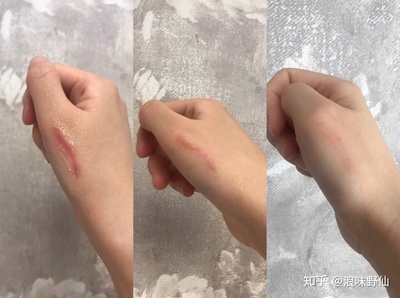 如何去除烫伤的疤痕