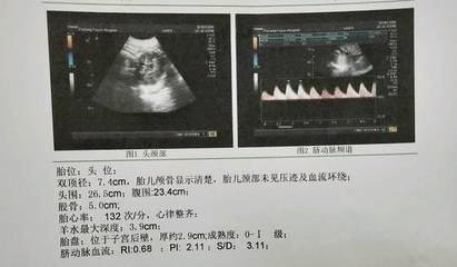 胎儿七个月双顶径标准