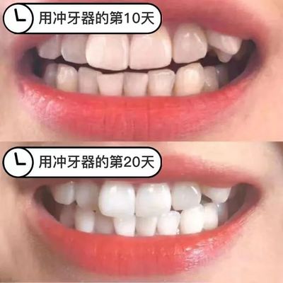 补牙后牙缝大了怎么办
