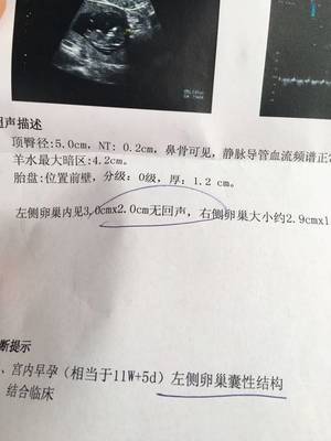 怀孕卵巢囊肿怎么办