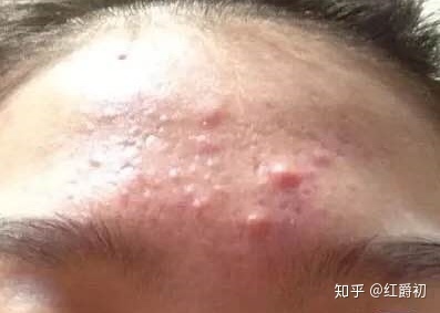 额头和背长痘痘