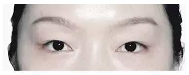 桃花眼必须是双眼皮吗