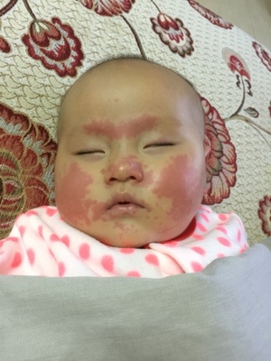 打完婴儿针起痘痘
