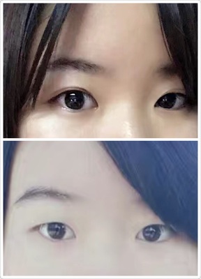 揉眼睛变双眼皮