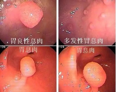 胃底腺增生怎么治疗