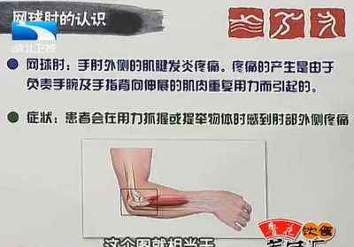 网球肘怎么治疗才能彻底恢复