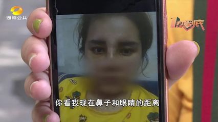 耳软骨隆鼻容易歪吗