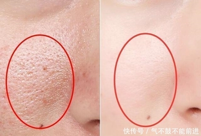 痘痘肌肤可以用精华液吗