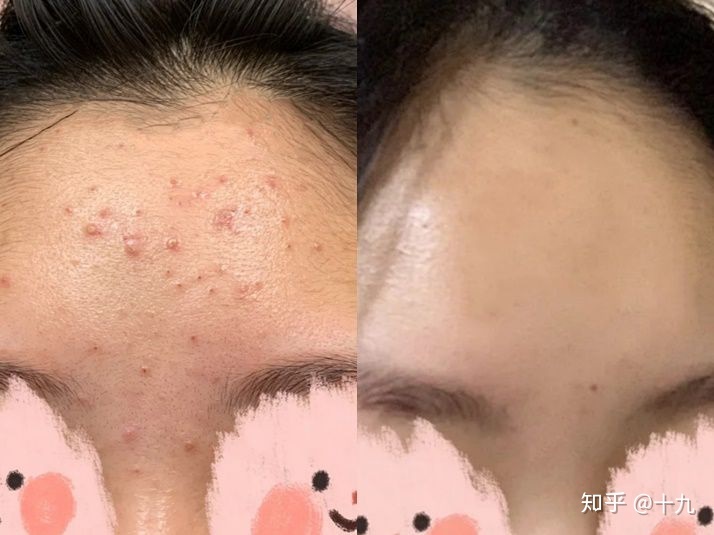 额头长闭口痘痘是什么原因