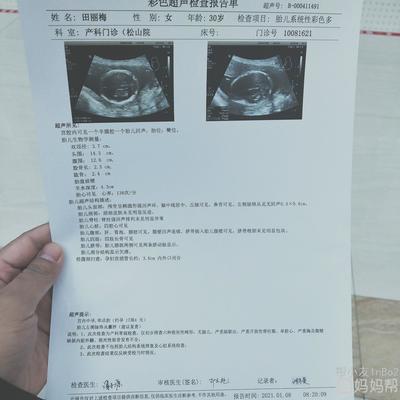 胎儿左侧脉络丛囊肿