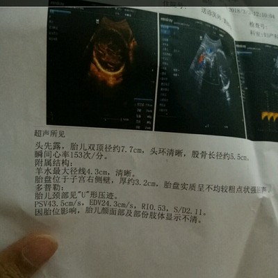 如何检查胎儿是否入盆