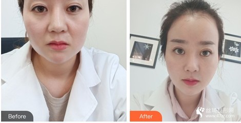 没洗脸敷面膜会怎么样