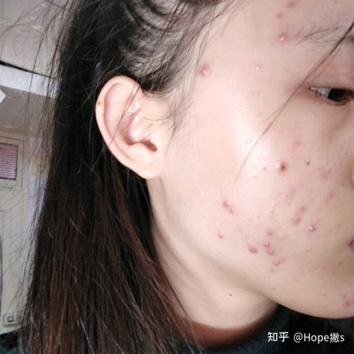 敏感肌肤痘痘发红