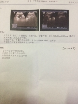 怀孕期间白带多