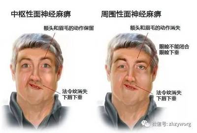 脸部麻是怎么回事