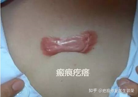 疤痕放疗