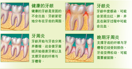 怎么治疗牙龈炎