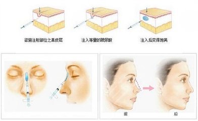 除皱原理