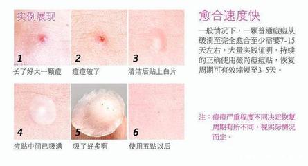 挤痘痘之后的伤口愈合