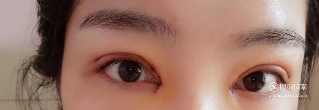 双眼皮结疤