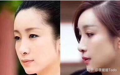 割了双眼皮后特后悔