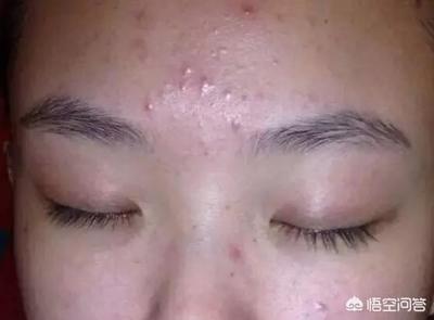 怎么除额头上痘痘