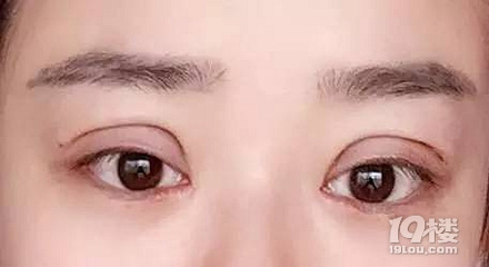 双眼皮修复失败