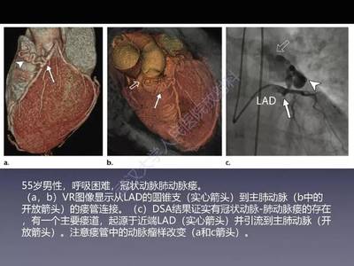 冠状动脉瘘怎么治疗