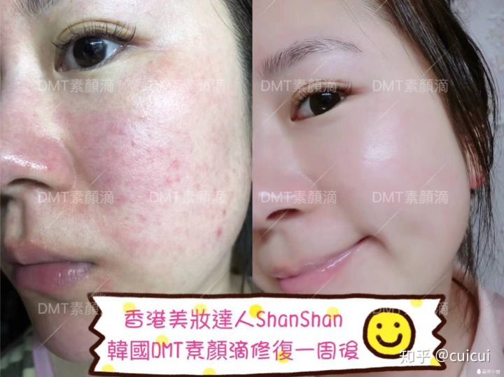 有痘痘用修复屏障