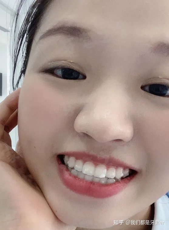 矫正牙齿打钉的好处