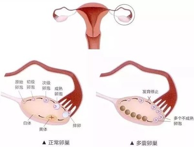 卵泡多怎么治疗
