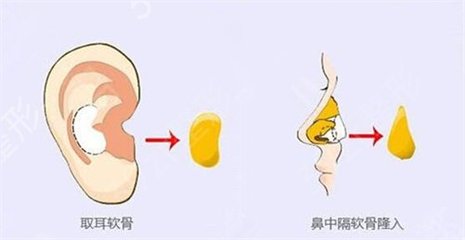 取耳软骨隆鼻疼吗