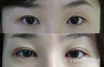双眼皮埋线有风险吗